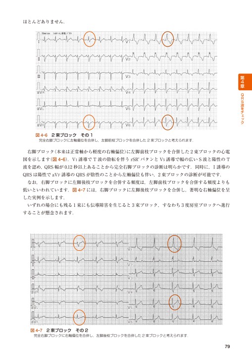 心電図 反 時計 回転 不 セール 完全 右 脚 ブロック